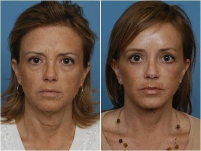 Browlift, Lower eyelid Surgery, Facelift - 
	This patient wanted a refreshed, natural look to her face. Performed a browlift, Lower Eyelid lift and Facelift.
