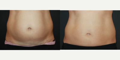 35-44 year old woman treated with CoolSculpting - Elite Freeze powered by CoolSculpting