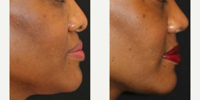 35-44 year old woman treated with Nonsurgical Nose Job, Morpheus8, Microneedling RF, Micro Botox, Botox - Treated by laser technician Alyssa Gutierrez and RN injector Aubrey Houchin. Morpheus8 for submental only as well as nose slimming botox for bunny lift of nose.
