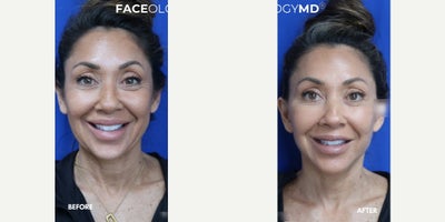 Woman treated with Facelift, Neck Lift - Woman treated with Facelift, Neck Lift