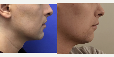 Patient treated with Adam's Apple Reduction - Thyroid Cartilage Shave - 25 to 34 year-old female patient is 1 year and 6 months post-op from Facial Feminization surgery. Her procedures included: Placement of Tissue Expander - Frontal, Septorhinoplasty (closed) with Cartilage Grafts, Cheek Implants (small), Chin Reduction and Contour, Intranasal Lip Lift with Fat Augmentation, and Thyroid Cartilage Shave. Patient is 1 year 3 months post-op from Removal Tissue Expander - Forehead Lift, Hairline Lowering, Orbital Bony Contouring, and 300 Micrografts to Recessions.