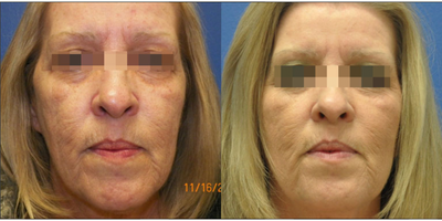 Woman treated with SmartSkin CO2 laser - Woman treated with SmartSkin CO2 laser