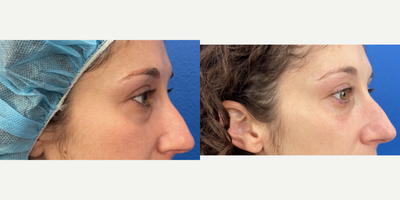 35-44 year old woman treated with Eyelid Surgery - Lower Blepharoplasty