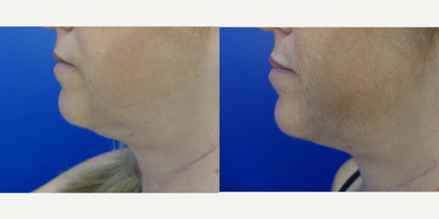 35-44 year old woman treated with CoolMini, CoolSculpting - 43 year old woman treated with the Coolsculpting CoolMini before and four months after her treatment