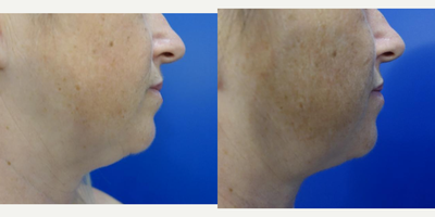 35-44 year old woman treated with CoolMini, CoolSculpting - 43 year old woman treated with the Coolsculpting CoolMini before and four months after her treatment
