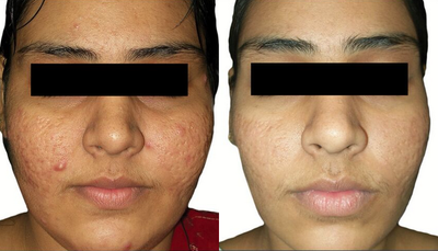 Venus Viva - Before and After 8 Treatments. &nbsp;Photos provided courtesy of Venus Concept, performed by Megha Joy Shah, MD.