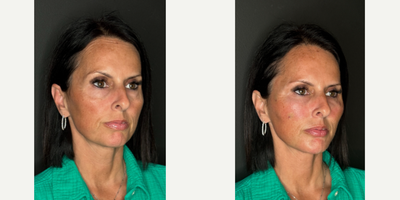 45-54 year old woman treated with PRF Treatment - This clients primary concern was her under eyes. Using PRF gel we injected under her eyes, to the temples and a small amount in her jawline and nasolabial folds.