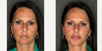 45-54 year old woman treated with PRF Treatment - This clients primary concern was her under eyes. Using PRF gel we injected under her eyes, to the temples and a small amount in her jawline and nasolabial folds.