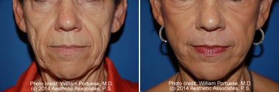 Dermabrasion - Dermabrasion