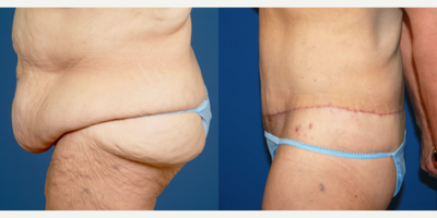 65-74 year old woman treated with Body Lift - Circumferential Abdominoplasty (Lower Body Lift). 125 pound weight loss - diet and exercise only.