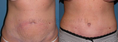 Tummy Tuck - 
	tummy tuck
