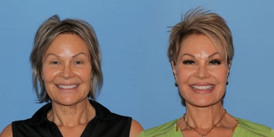 Woman treated with Deep Plane Facelift - Woman treated with Deep Plane Facelift