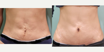 25-34 year old woman treated with ThermiTight, Tummy Tuck Revision - 28 year old who underwent revision of umbilicus scar with Thermitight