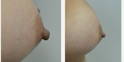 35-44 year old woman treated with Nipple Reduction Surgery - A woman in her late 30s who is bothered by an embarrassing prominence of her nipples in clothing. She is shown before and again, 7 weeks after bilateral nipple papule reduction in the office under local anesthesia using a modified, Top Hat Flap method. This allows the reduction of both the nipple height and width, while preserving the core of the nipple and nipple sensation.