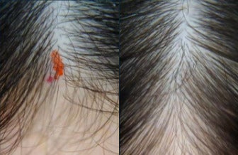 51 year old woman treated with PRP for Hair Loss, Exo-Xom, FUE Hair Transplant - 51 year old woman treated with PRP for Hair Loss, Exo-Xom, FUE Hair Transplant