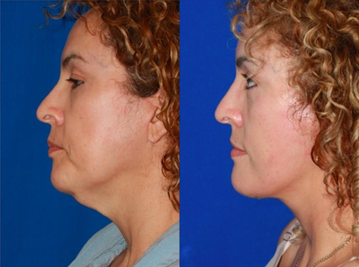 Woman treated with Facelift Revision - This patient recently underwent a facelift with another doctor. However, she was dissatisfied with the lack of improvement in the neck. Secondary face and neck lift was performed to restore youthful neck contour.