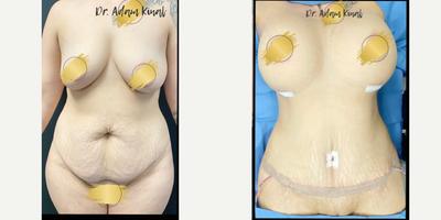 25-34 year old woman treated with Diastasis Recti Repair, Smart Lipo, Breast Reconstruction - The patient presented for a mommy makeover including diastasis recti repair, tummy tuck, liposuction, and breast augmentation.