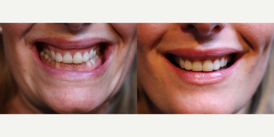25-34 year old woman treated with Botox to correct gummy smile - improvement in visible gum line after botox for gummy smile treatment