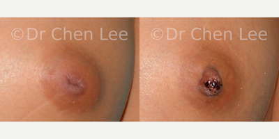 18-24 year old woman treated with Nipple Surgery - INVERTED NIPPLE SURGERY BY DR CHEN LEE AT COSMETIC SURGERY MONTREALThis 22-year-old woman had a left-sided inverted nipple that everted only to manual stimulation. She desired surgical correction so that the inverted left nipple would look symmetrical with her normal right nipple. Surgery was performed with the following notables:- 30-minute procedure- outpatient surgery- local anesthesia- left grade 2 nipple inversion- interferes with future ability to breastfeed  - Photographs were taken before and 4 days after corrective surgery for nipple inversion.Note that surgical cases of Dr. Chen Lee are presented for illustrative and educational purposes only. These illustrative cases should not be construed as a guarantee nor assurance as to the surgical results attainable by prospective patients.*******************************************************************************************************************************************MAMELON INVERS PAR DR CHEN LEE  CHIRURGIE PLASTIQUE MONTRALCette jeune femme de 22 ans avait un mamelon invers du ct gauche. Elle pouvait le faire resortir par stimulation manuelle seulement. Elle souhaitait une correction chirurgicale afin que le mamelon gauche invers soit symtrique par rapport au mamelon droit. La chirurgie a t ralise avec les notes suivantes:- Procdure de 30 minutes- Chirurgie ambulatoire- Anesthsie locale- Mamelon gauche invers  grade 2- Futur allaitement impossible pour le cot gauche.- Les photographies ont t prises avant et 4 jours aprs la chirurgie corrective dinversion du mamelon.Notez que les cas de chirurgie du Dr. Chen Lee sont prsents  titre indicatif et ducatives seulement. Ces cas illustration ne doit pas tre interprt comme une garantie ni comme une assurance quant aux rsultats chirurgicaux ralisables par les patients potentiels.