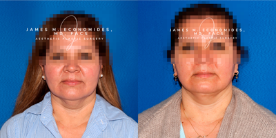 50 year old female who underwent facelift - 50 year old female who underwent facelift