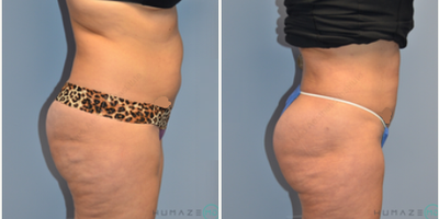 41-50 year old woman treated with Brazilian Butt Lift - 41-50 year old woman treated with Brazilian Butt Lift