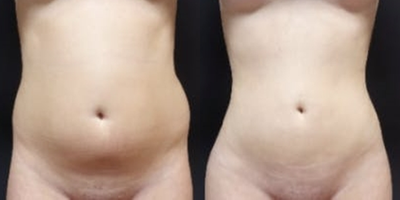 18-24 year old woman treated with Butt Augmentation - The patient underwent a Brazilian Butt Lift (fat transfer for butt augmentation). The combination of the liposculpting and the fat transfer transformed her from square to an hourglass figure.