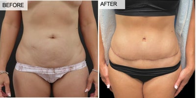 35-44 year old woman treated with Tummy Tuck - My lovely patient is shown 3 months after tummy tuck surgery and she looks amazing!