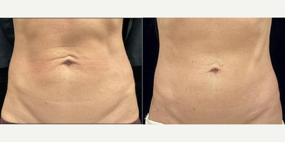 40 year old woman treated with Morpheus8 - 40 year old woman treated with Morpheus8.
