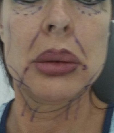 Best Price For A Mini Face Lift In Tijuana Review Realself