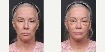 65-74 year old woman treated with Deep Plane Facelift, Facelift Revision, Eyelid Surgery, Facial Fat Transfer - Facelift RevisionNeck liftFat GraftSubmentoplastyLower Blepharoplasty Revision