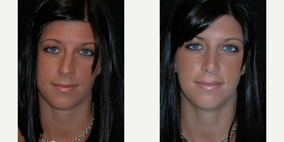 25-34 year old woman treated with Septoplasty - Open Functional Preservation Rhinoplasty with septoplasty for crooked nose
