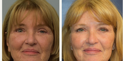 65-74 year old woman treated with Eyelid Retraction Repair - A woman in her 60s with a complex bilateral eyelid problem after blepharoplasty at an outside facility.  She presented with a retracted open right eyelid and ptosis of the left eyelid.  She is now 1 month post-op right eyelid levator muscle release of overly plicated previous blepharoplasty and left eyelid ptosis repair.  Scar minimizing technique employed for a natural appearing result.