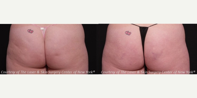 35-44 year old woman treated with Cellfina - Cellfina&trade; is a minimally invasive procedure that has been clinically proven to significantly reduce the appearance of cellulite on the buttocks and thighs for at least one year. Cellfina&trade; is the only minimally invasive procedure for cellulite that has been FDA approved.
