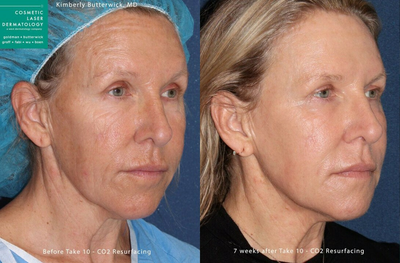 Woman treated with Fraxel Repair - Fraxel Repair for Skin Rejuvenation by Dr. Butterwick