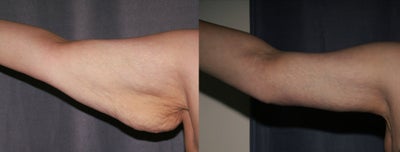 Arm Lift (Brachioplasty) - 
	Front view of an arm lift (brachioplasty), before and after.
