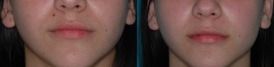 17 or under year old woman treated with Mole Removal - 17 year old after mole removal from rea above the lip.