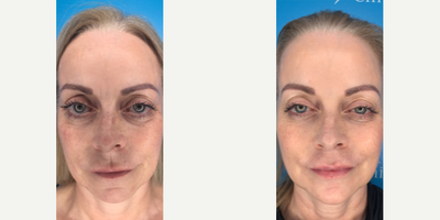 45-54 year old woman treated with Ellanse - This lady felt she was aging and she disliked that her eyes were dominating her face. She had Ellans S and M injected in a global manner and she was delighted with her holistic rejuvenation. In particular, she had temple, cheek, and chin injections with Ellans, and her old lip filler was dissolved and lips refilled, to achieve a really balanced face.
