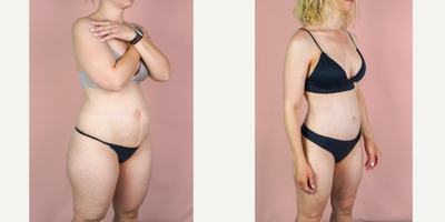 35-44 year old woman treated with Mommy Makeover, Tummy Tuck, Breast Augmentation, Liposuction, Breast Implants - This lovely patient is shown 3 months post-op from mommy makeover consisting of a breast augmentation, abdominoplasty and liposuction. She came to me after hitting a plateau along her journey to a slimmer physique. Oftentimes, diet and exercise are not enough and surgery is needed to tighten muscles and remove excess skin. Her implants were smooth, round silicone and they were placed in a dual-plane to allow a small amount of lift. Here, you can see a huge transformation. Her results are exceptional because she adopted a healthy lifestyle after surgery to continue to improve upon her results.