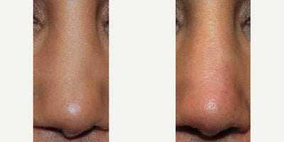 Non-Surgical Rhinoplasty Before & After: Corrected Nostril Asymmetry and Sidewall Indentation - Our lovely patient traveled from afar to see us for our expertise with permanent non-surgical nose job treatments. She had a rhinoplasty one year ago in her country, and she was dissatisfied with the asymmetry of her nostrils on front view, along with the appearance of an indentation along her left nasal sidewall. The after photo is following a single treatment with Silikon-1000 to both nostril margins, her infratip lobule, and her left nasal sidewall. You can see a natural-looking, more symmetrical, and pleasing alar base after her treatment. Also see an improvement in the appearance of the indentation along her left nasal sidewall.