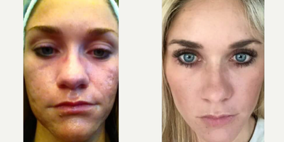 25-34 year old woman treated with Bellafill - Before and after Bellafill for the treatment of acne scars