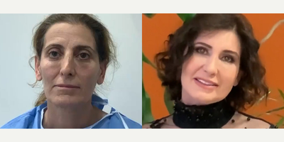 49 year old woman treated with Cheek Augmentation - 49 year old woman treated with Cheek Augmentation through facial fat transferas well asMini Facelift,Brow Lift, Eyelid Surgery, andRevision Rhinoplasty,shown 8 months post op. Pre-op, she did not find herself beautiful and felt that she looked very old.