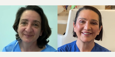 50 year old woman treated with Cheek Augmentation - 50 year old woman treated with Cheek Augmentation through facial fat transfer as well as Deep Plane Facelift, Neck Lift, Rhinoplasty,Eyelid Surgery, and Lip Lift,shown 3 years post op.