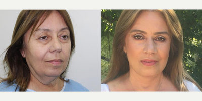 66 year old woman treated with Cheek Augmentation - 66 year old woman treated with Cheek Augmentation through facial fat transfer as well as Deep Plane Facelift,Neck Lift, Eyelid Surgery, andLip Lift,shown 8 months post op.