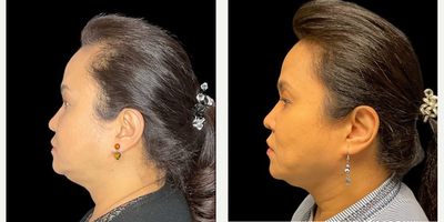 55-64 year old woman treated with Nonsurgical Facelift, Renuvion for Facial Resurfacing - Patient: Female, 59Procedure: Renuvion Mini FaceliftRecovery: 9 months
