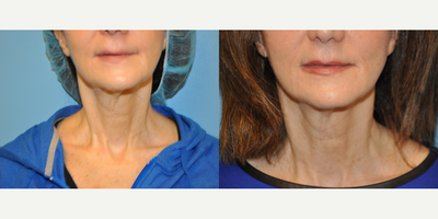 55-64 year old woman treated with ThermiTight - 64 year old female underwent ThermiTight surgery under local anesthesia