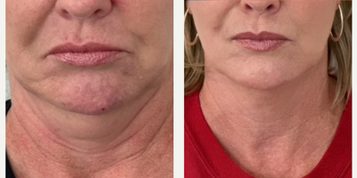 Woman treated with Botox - Woman treated with Botox