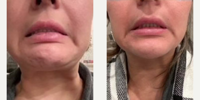 Woman treated with Botox - Woman treated with Botox