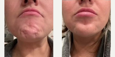 Woman treated with Botox - Woman treated with Botox