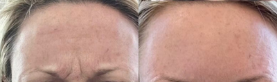 Woman treated with Botox - Woman treated with Botox