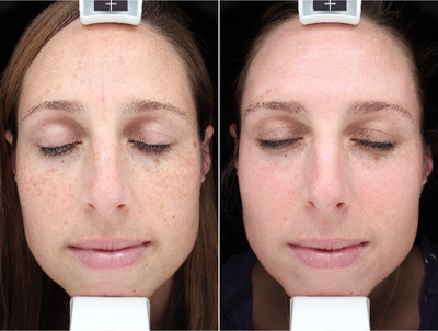 45-54 year old woman treated with Halo Laser - After 1 Halo Treatment